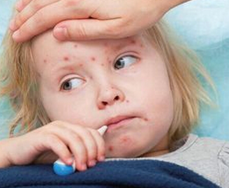 儿童荨麻疹有哪些表现症状