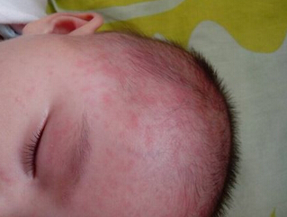 宝宝湿疹,宝宝头上有小疙瘩