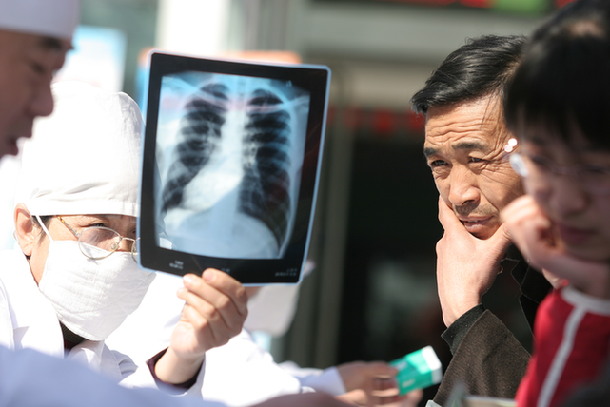 肺癌体检必知：X胸片逐渐淘汰 低剂量CT成筛查新贵