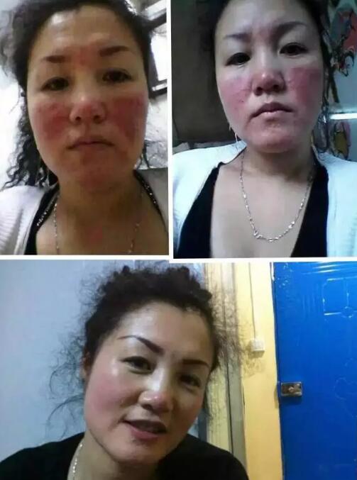 患者服用北京绿色动力后 重新拥有一张光滑的脸
