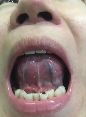 弘泽堂绿色动力把患者舌下静脉血栓完全调理好了